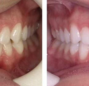 Class I with Class III tendency - Crowding (SureSmile Aligners)