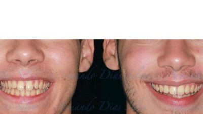 Class II, Div 1 – Central Incisor Protrusion and Anterior Spaces (SureSmile Aligners)