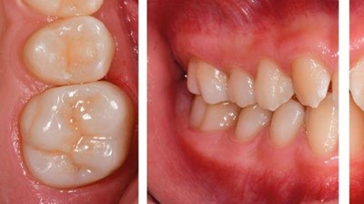 MIH Teeth Treatment – Restoration with CEREC Tessera