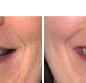 Mild Class II – Narrow Arches (SureSmile Aligners)